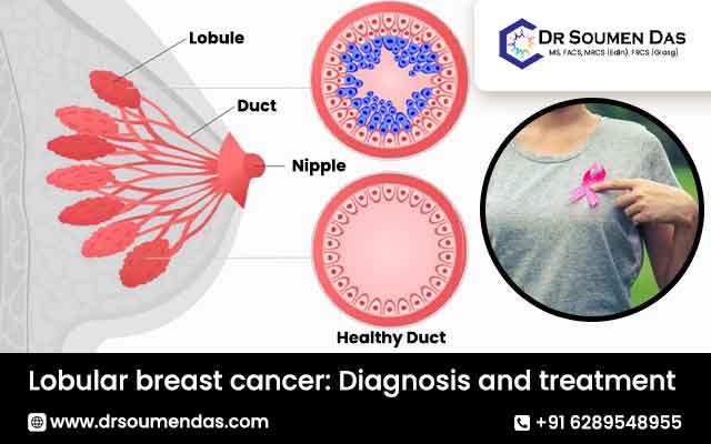 lobular breast cancer
